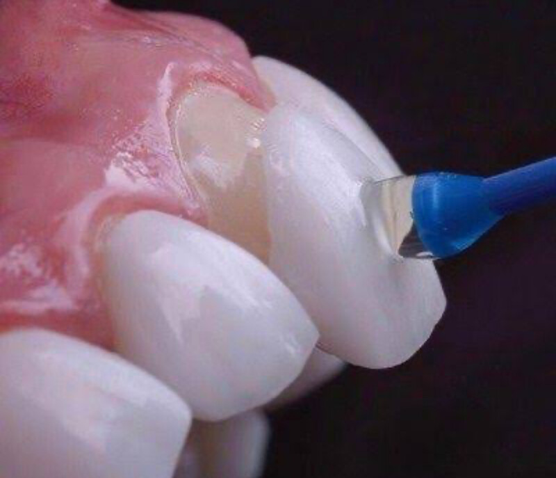 Transformação com Lentes de Contato Dentárias