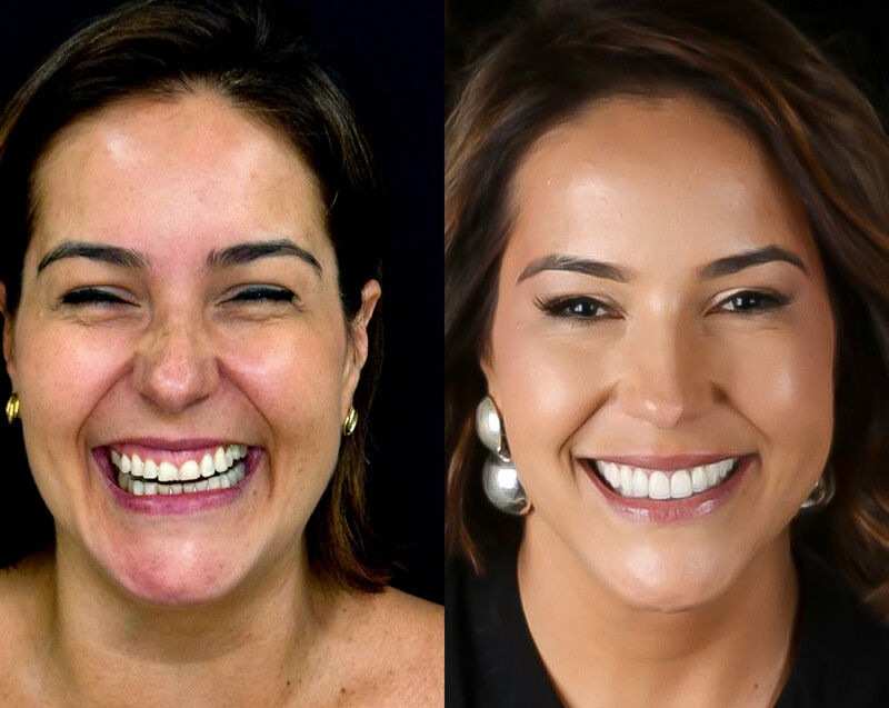 Reabilitação Oral Completa