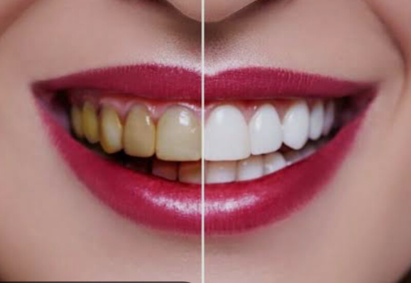 Harmonização do Sorriso