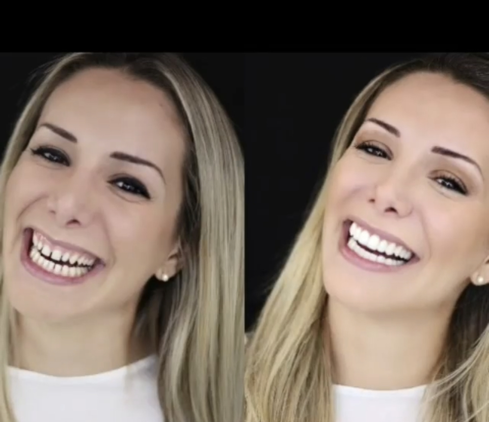 Gengivoplastia - Correção do Sorriso Gengival